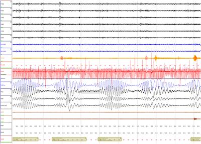 Case report: A case of complete resolution of obstructive and central sleep apnea with Cheyne Stokes breathing in a patient with heart failure 60 days post-left ventricular assist device implantation